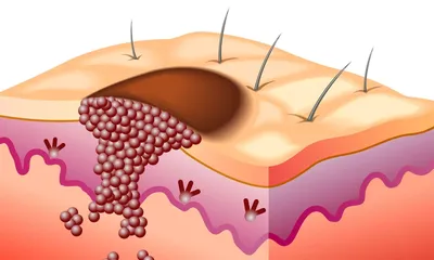 Плоскоклеточный рак кожи, самая начальная стадия. Болезнь Боуэна. |  dr.dzhunkovskaya | Дзен