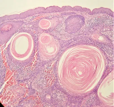Плоскоклеточный рак кожи (спиноцеллюлярный рак, эпидермоидная карцинома) —  это злокачественная опухоль, развивающаяся из кератиноцитов… | Instagram