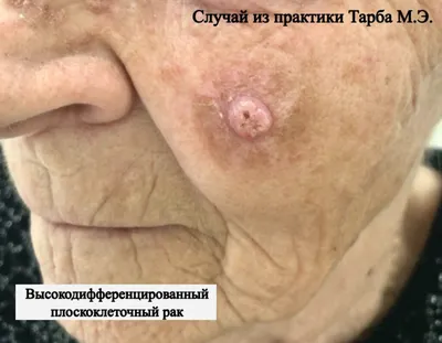 Плоскоклеточный рак кожи носа фото фото