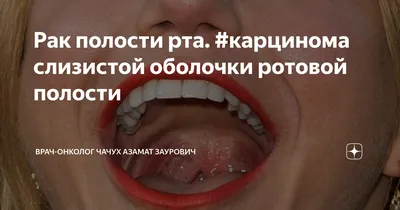 ВИЧ-инфекция: проявления в области рта при СПИДеDENTALMAGAZINE.RU