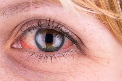 Красные глаза у ребенка 👀 Информационный портал Детское зрение