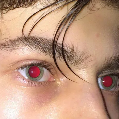 Распространенные причины красных глаз