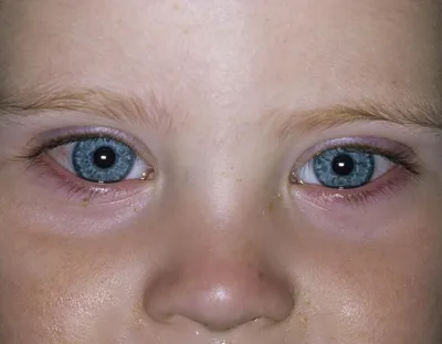 Натуральные средства от красных глаз: эффективные способы избавиться от  покраснений