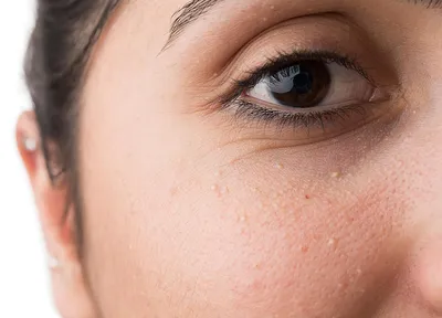 Как убрать милиумы на коже лица и избавиться от них в домашних условиях:  удаление белых угрей вокруг глаз и почему они появляются