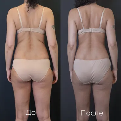 Вакуумно-роликовый массаж тела — Анна Золотова на TenChat.ru