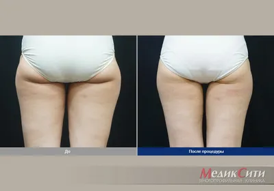 Криолиполиз Coolsculpting ZELTIQ в Москве | Цены на криолиполиз  Coolsculpting by ZELTIQ