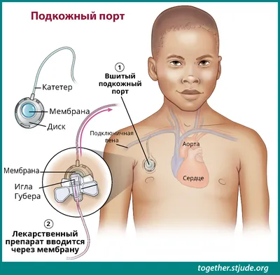 Подключичный катетер 1,0