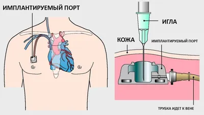 Медицинский ротовой стерильный катетер, 100 шт | AliExpress