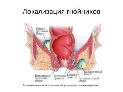 Абсцесс мягких тканей