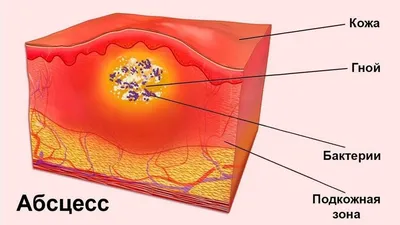 Вскрытие абсцессов в Орле - Эс Класс Клиник