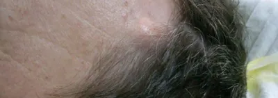 Соскобы кожи и ресницы на клещи (демодекс) - «Мое лицо на фото до лечения и  после» | отзывы
