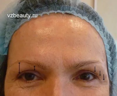 Лифтинг (поднятие) бровей с помощью «ботокса» — vzbeauty.ru