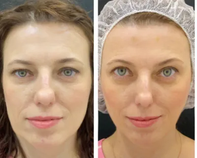 Как меняется лицо после 10 лет инъекций ботокса: фото | DOCTORPITER