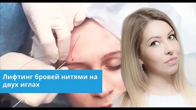 Подтяжка лица нитями Aptos в Москве в центре VersuaClinic, цены, отзывы