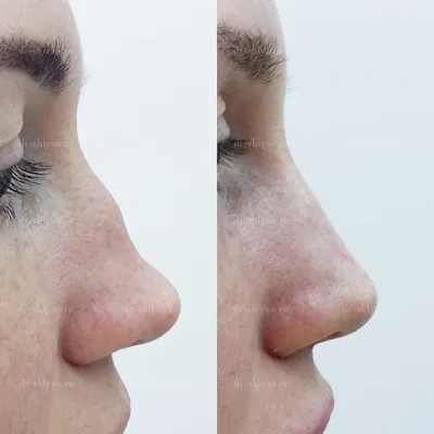 Безоперационная ринопластика (пластика носа без операции) | Интервью с  косметологом