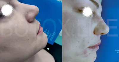 Ботокс в кончик носа до и после. Корректировка размера носа без