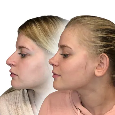 Ринопластика без операции — коррекция носа филлерами всего за 5 минут
