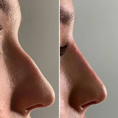 Фото до и после уколов ботокса в нос. Будет ли форма идеальной? | Красота и  уход | Дзен