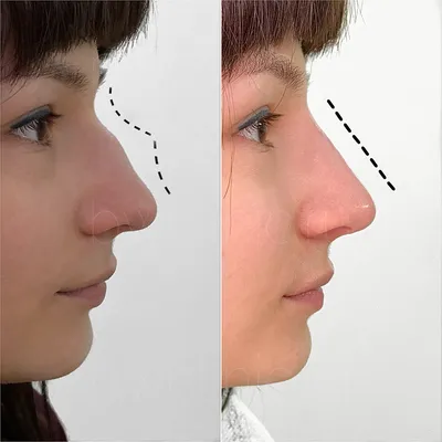 Поднять кончик носа - косметологическая клиника Шестаковых