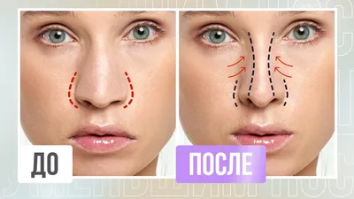 Контурная пластика носа в Москве- ЦИДК