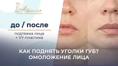 Инъекции ботокса в Москве | Цены на инъекции ботокса в Medispa Biosfera