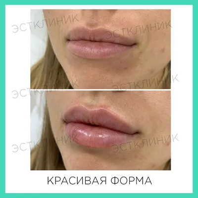 Увеличение губ филлерами, цены от от 19000 руб. в Москве | Клиника Beauty  Trend