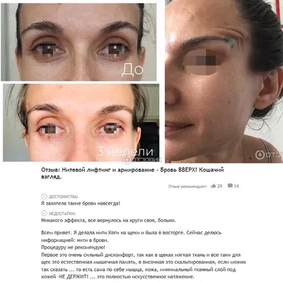 Fox eyes», «лисьи глазки» и «browlift». Опасная процедура.