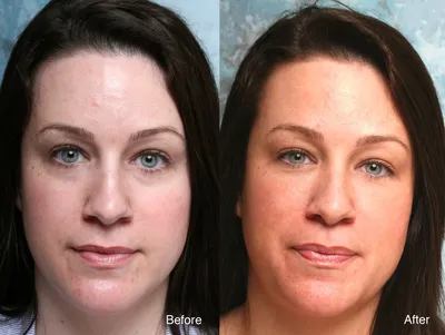 Инъекции ботулотоксина фото до и после процедуры в клинике в Москве -  Cosmetic-clinic