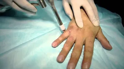 Меланома ногтя: причины, признаки, лечение, прогноз | МЦ Лазерсвiт