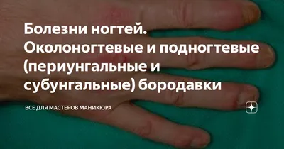 Скрученные ногти: причины, лечение, выпрямление, советы.