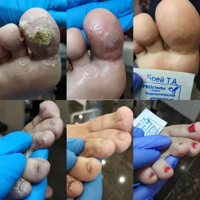 Подошвеннные бородавки на ногах, фото, лечение, удаление в Днепропетровске  Украина