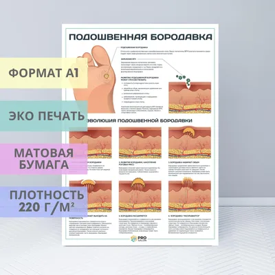 Методы удаления бородавок: сравнение преимуществ и недостатков разных  методов удаления бородавки