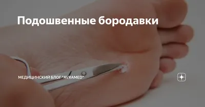 Лазерное удаление бородавки в Санкт-Петербурге недорого | Центр лазерной  эпиляции
