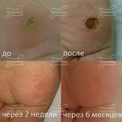 Бородавки: симптомы, причины, диагностика и лечение бородавок в Москве -  сеть клиник «Ниармедик»