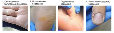 Удаление бородавок (шипиц) лазером на лице и подошвенных бородавок в Москве  в клинике лазерной хирургии и косметологии «Вектор»
