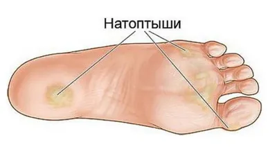 Мозоли: стержневая мозоль, мозоль на ноге, на пальце, пластырь от мазолей