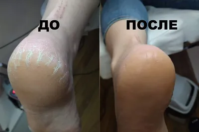 Лечение и удаление мозолей на ногах | Подолог в Алматы