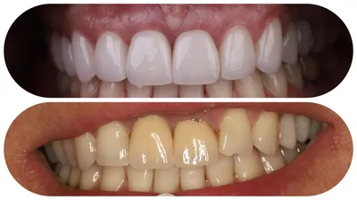 Фото зубов до и после