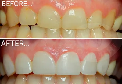 Художественная реставрация зубов в Калининграде, услуга: виды, цены, акции,  примеры
