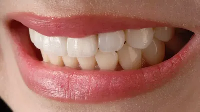 Сколько носят брекеты на зубах – минимальный и максимальный срок