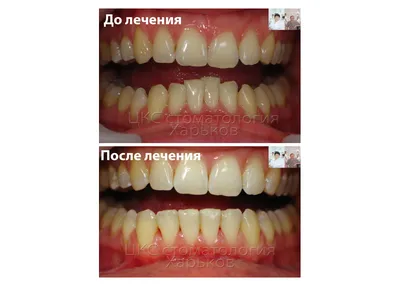 Лечение кривых зубов. Керамические и металлические брекеты в действии