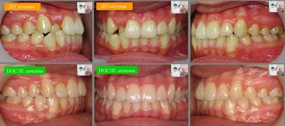 Косметическая реставрация зубов в Красноярске | Cтоматология Люксар