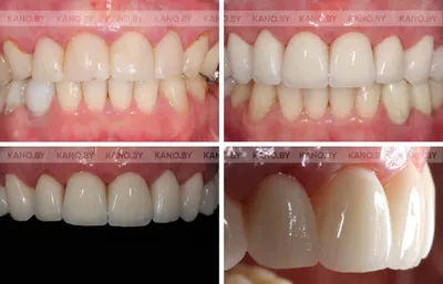 Реставрация зубов в Волгограде по цене от 3 280 рублей