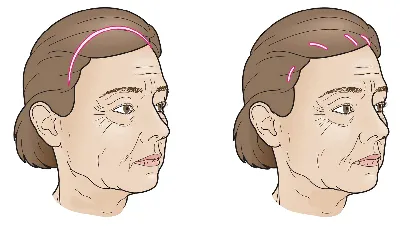 Эндоскопическая подтяжка бровей и лба – цена пластики в Киеве —  Пластическая операция на бровях в Киеве