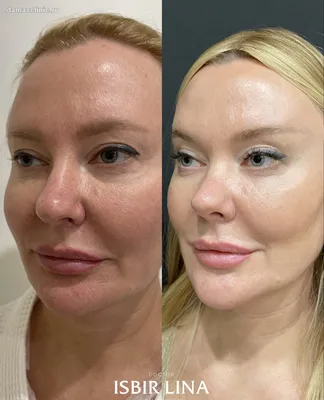 Подтяжка бровей / Brow lift в Москве в Damas Medical Center