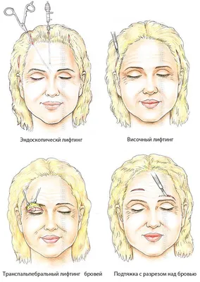 Подтяжка бровей и лба (фронтлифтинг) — Клиника \"Нефертити\"