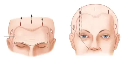 Эндоскопическая подтяжка лба и бровей в Москве: цены, сделать операцию у  профессионалов | Клиника Доктора Росса