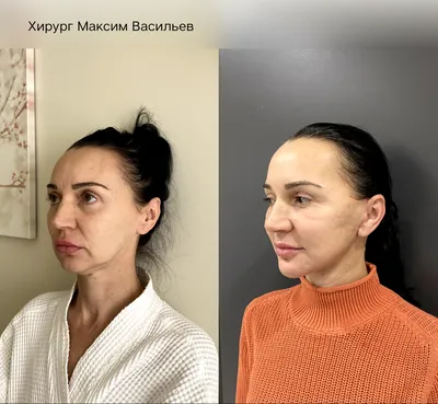 Хирургическая подтяжка лица - фейслифтинг, стоимость контурной подтяжки  лица в клинике Оренбурга