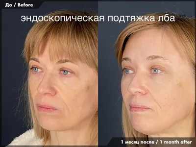 Подтяжка бровей / Brow lift в Москве в Damas Medical Center