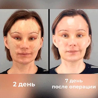 До / После — Эндоскопическая подтяжка верхней и средней зоны лица — Москва
